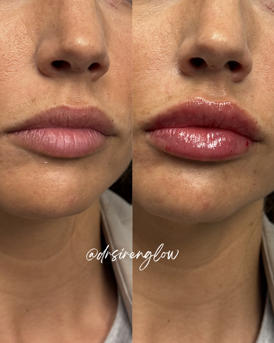 Before and after Lip Filler result at Siren Glow Aesthetics