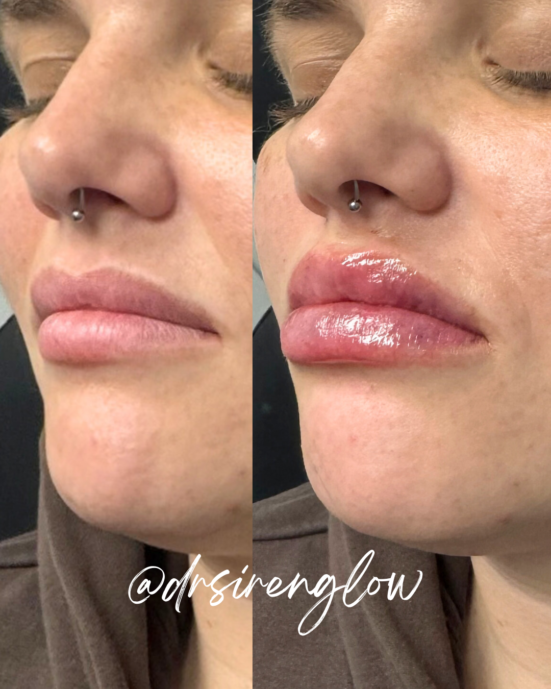 Before and after Lip Filler result at Siren Glow Aesthetics
