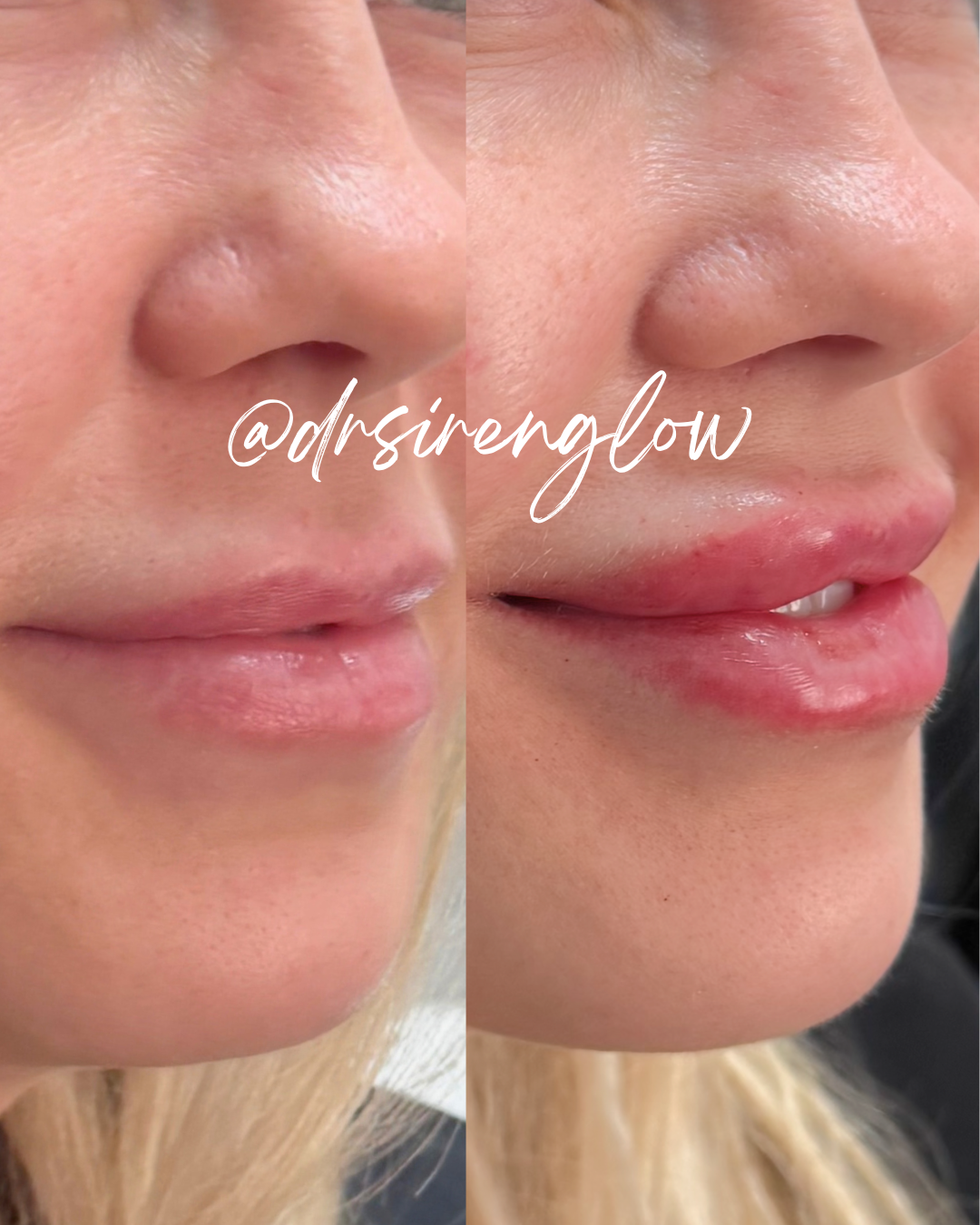 Before and after Lip Filler result at Siren Glow Aesthetics