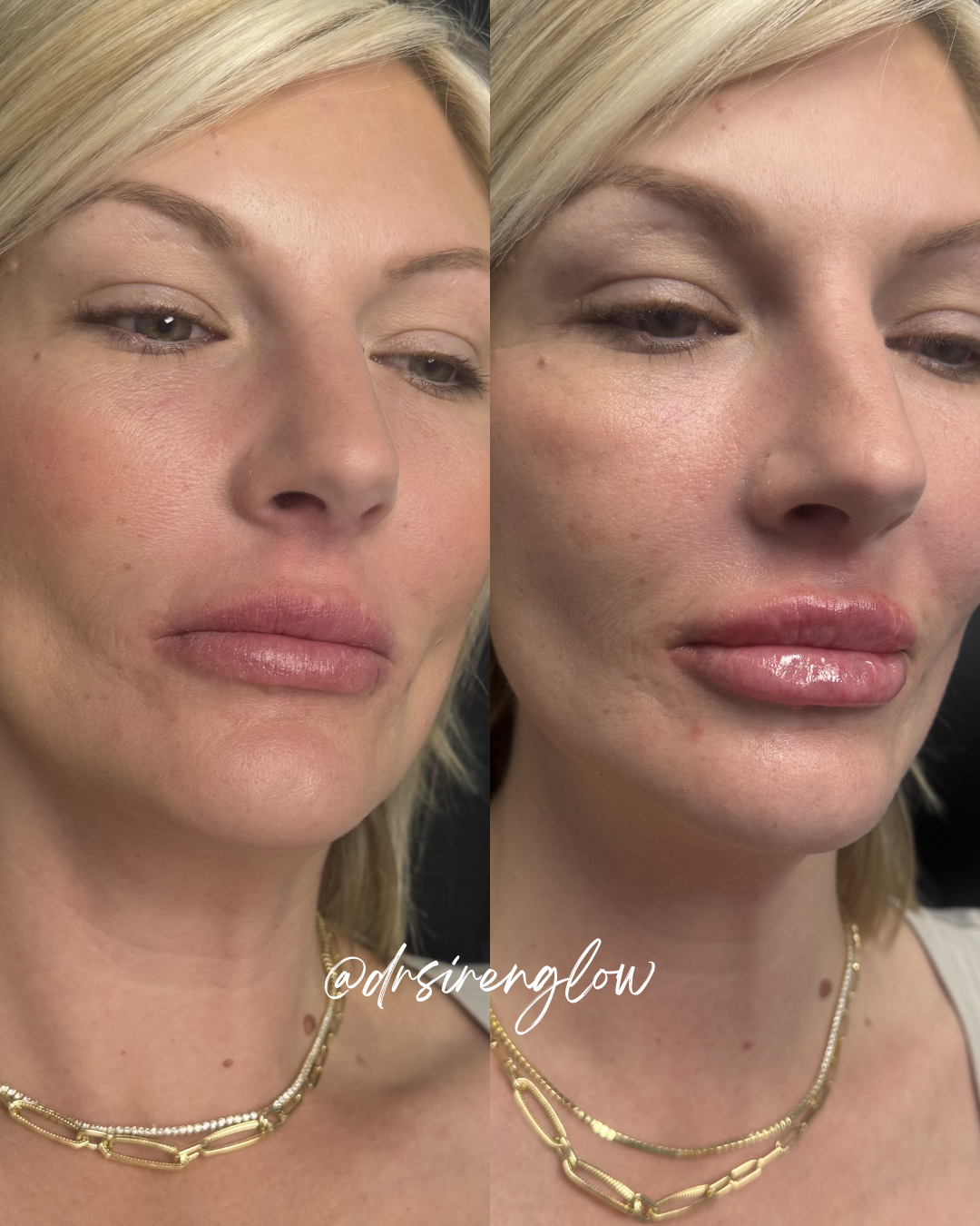 Before and after Lip Filler result at Siren Glow Aesthetics