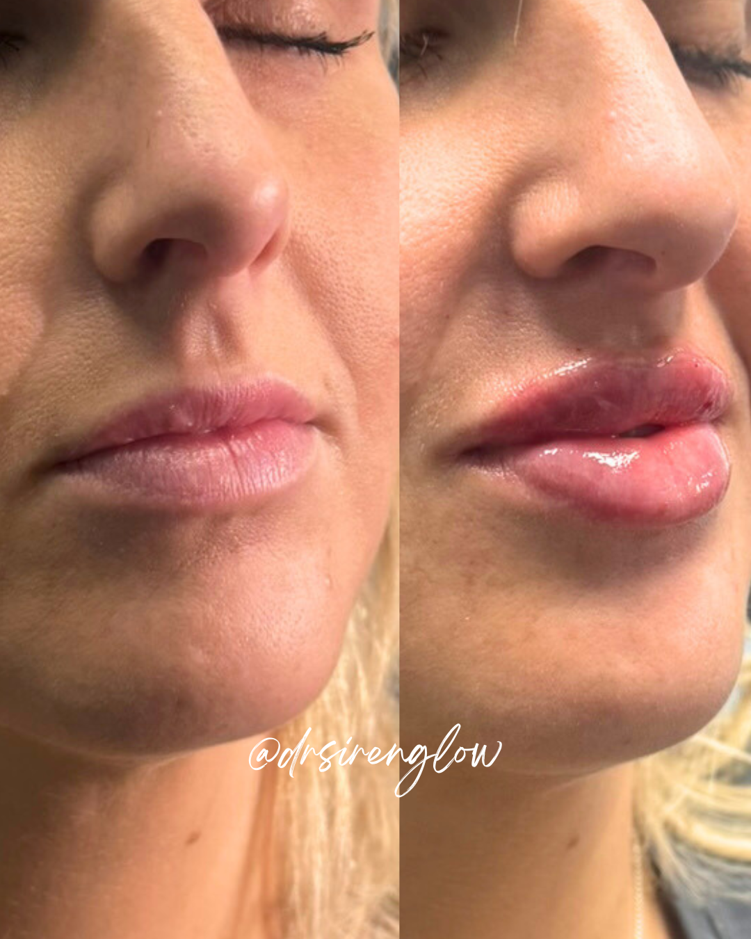Before and after Lip Filler result at Siren Glow Aesthetics
