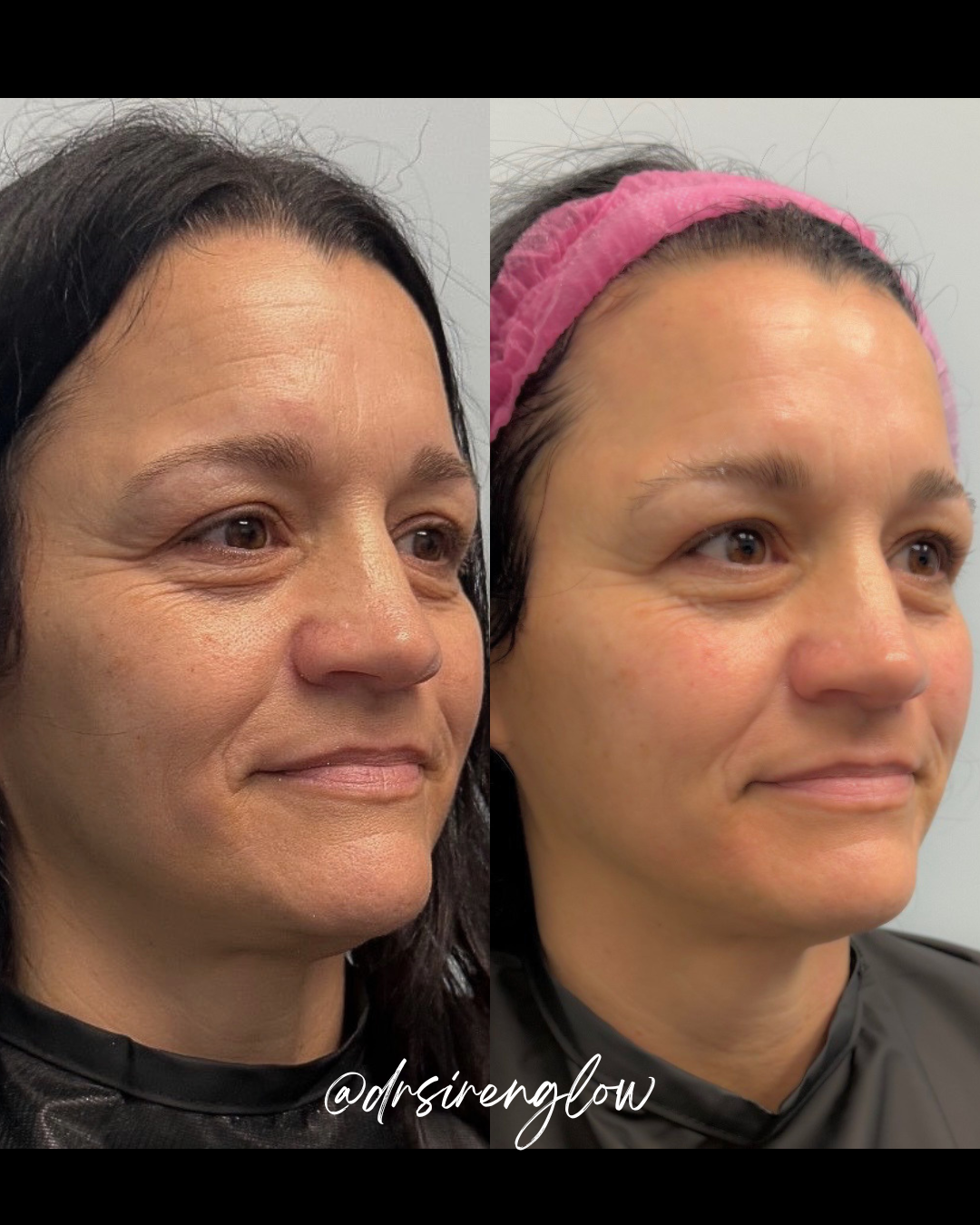Before and after Monopolar Radiofrequency result at Siren Glow Aesthetics