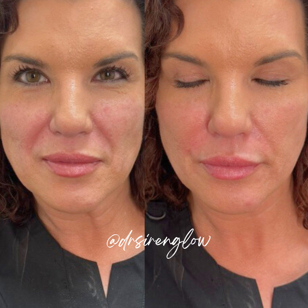 Before and after Nasolabial Fold Filler result at Siren Glow Aesthetics
