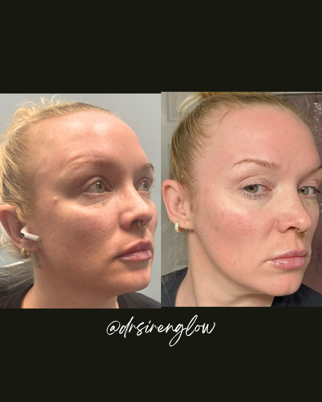 Before and after VI Peel Chemical Peel result at Siren Glow Aesthetics